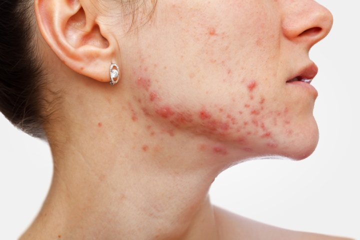 Acne da Mulher Adulta